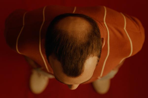 Overhead shot of a man, with male pattern baldness